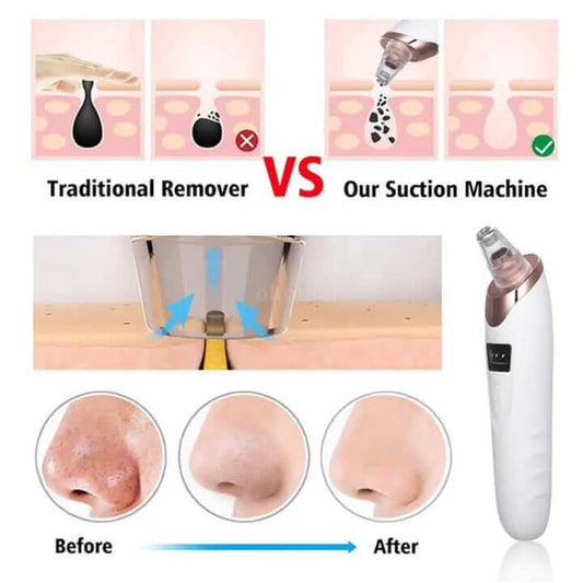 ππ€ USB Rechargeable Pore Cleaner β Bye-Bye Blackheads πβ¨