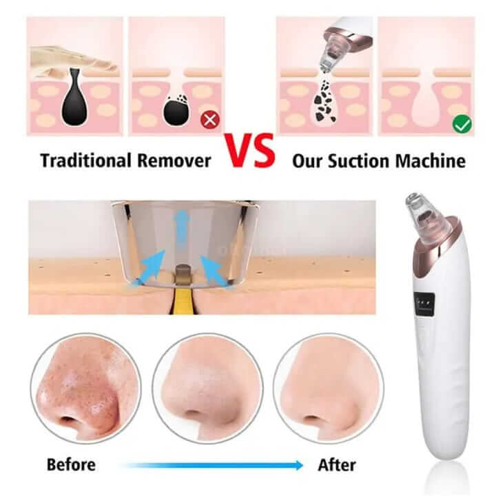 🔌🖤 USB Rechargeable Pore Cleaner – Bye-Bye Blackheads 👋✨